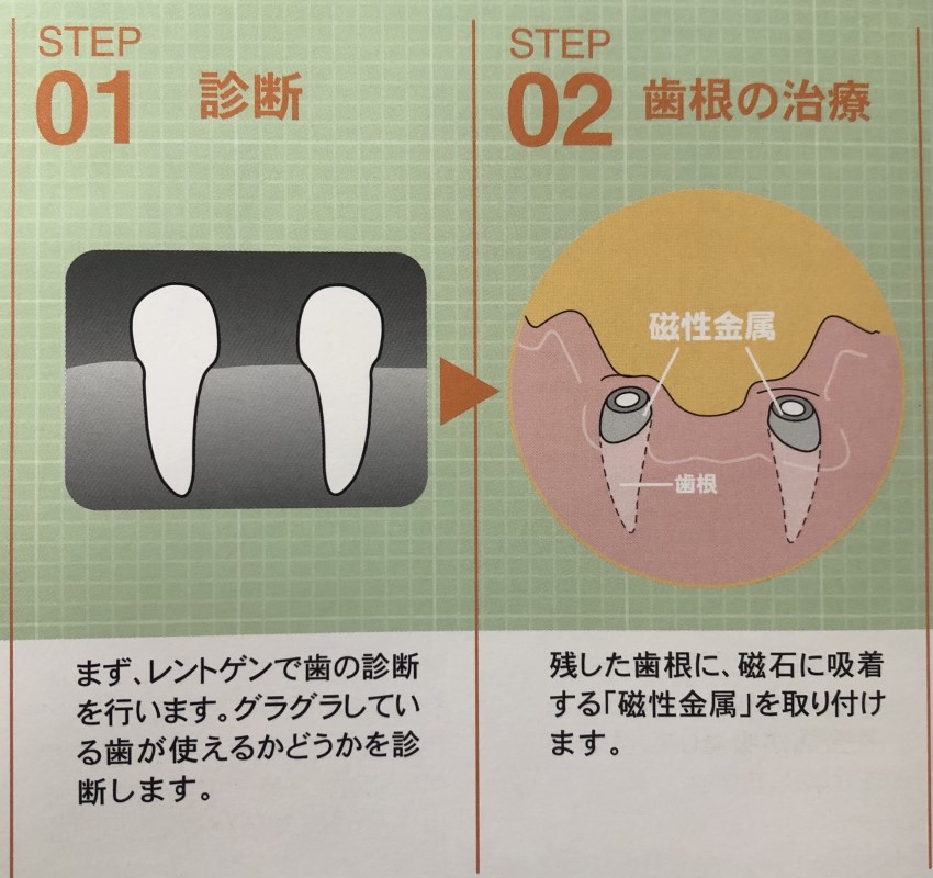 残根上義歯1