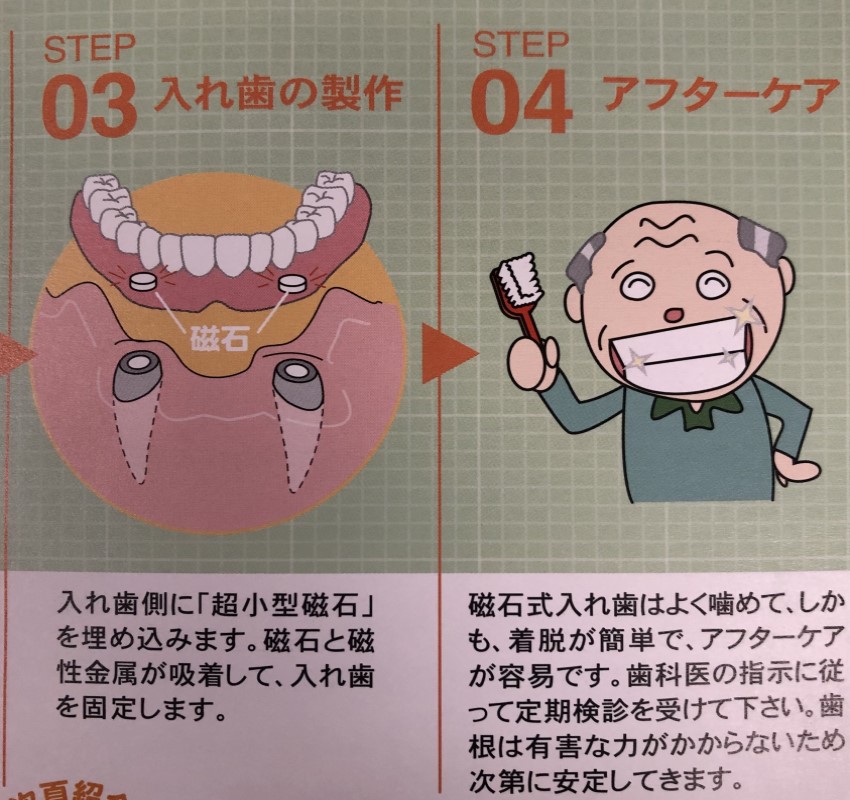 残根上義歯2